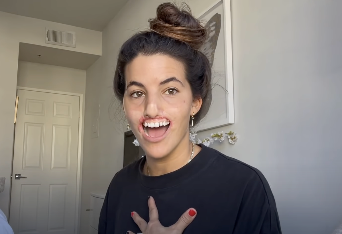 Influencer and model undergoes reconstructive face surgery after dog attack