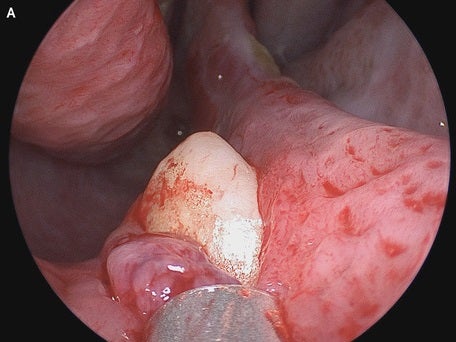 The ectopic tooth in question that grew on the floor of the man’s septum or the cartilage that separates the nostrils