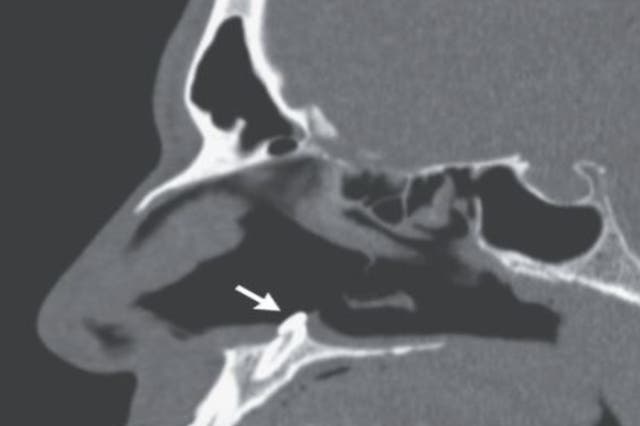<p>The ectopic tooth seen here growing inside the nose of a man causing breathing difficulties for him </p>