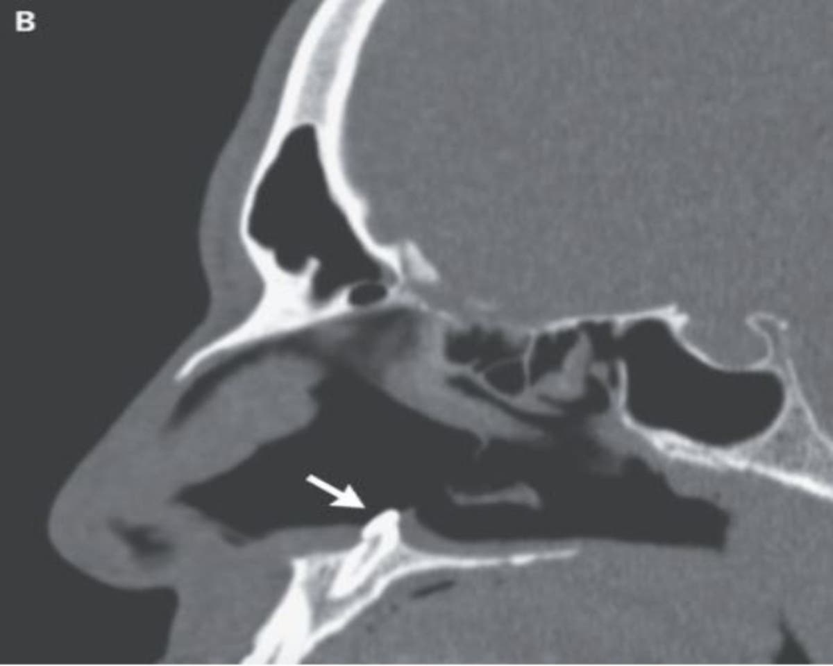 Doctors solve man’s breathing problems by finding a tooth growing inside his nose