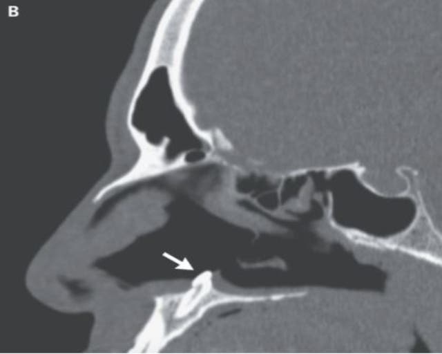 <p>The ectopic tooth seen here growing inside the nose of a man causing breathing difficulties for him </p>