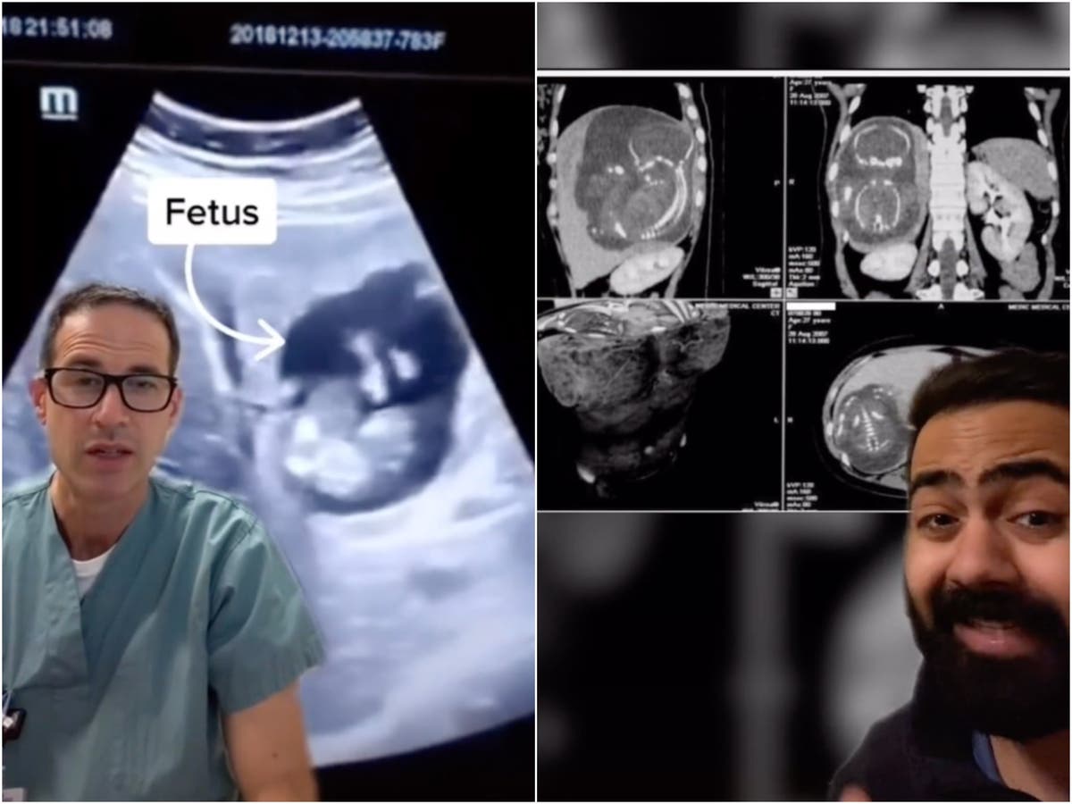 Woman&rsquo;s story goes viral on TikTok after baby found growing inside her liver