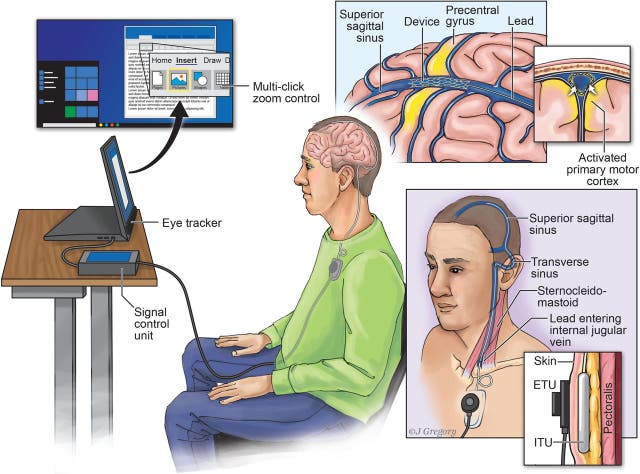 Synchron’s Stentrode device allows direct communication between a human brain and a computer, without the need for typing or speaking