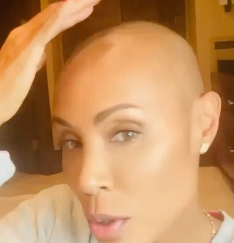 Jada Pinkett Smith has had alopecia since 2018