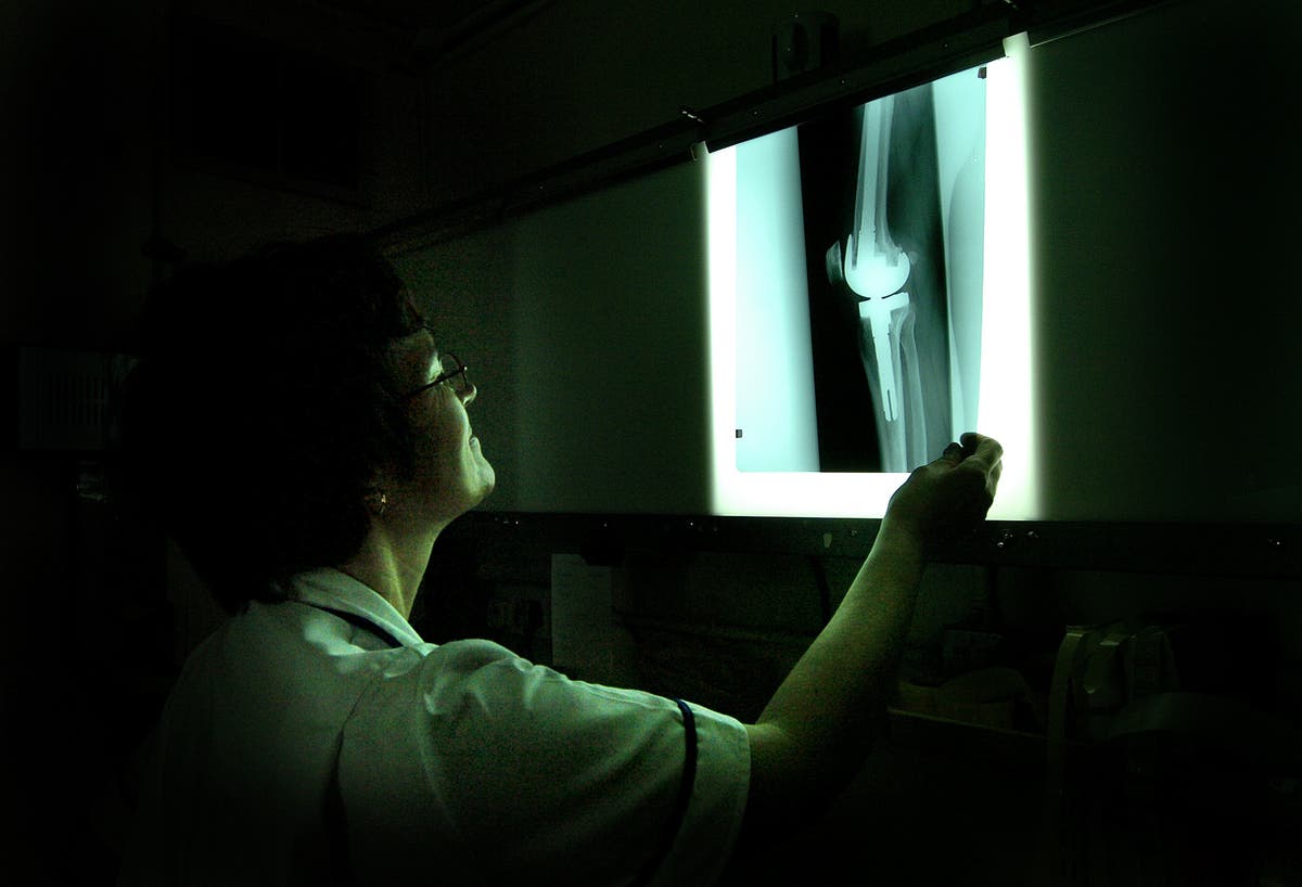 NHS medics call for osteoporosis drug to be recommended in England and Wales