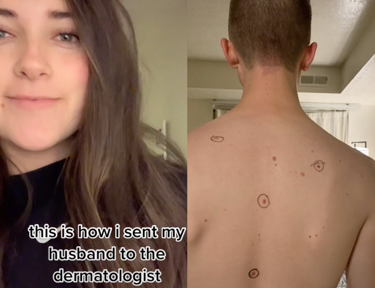 A woman received notes back after circling her husband&rsquo;s moles before his dermatologist appointment