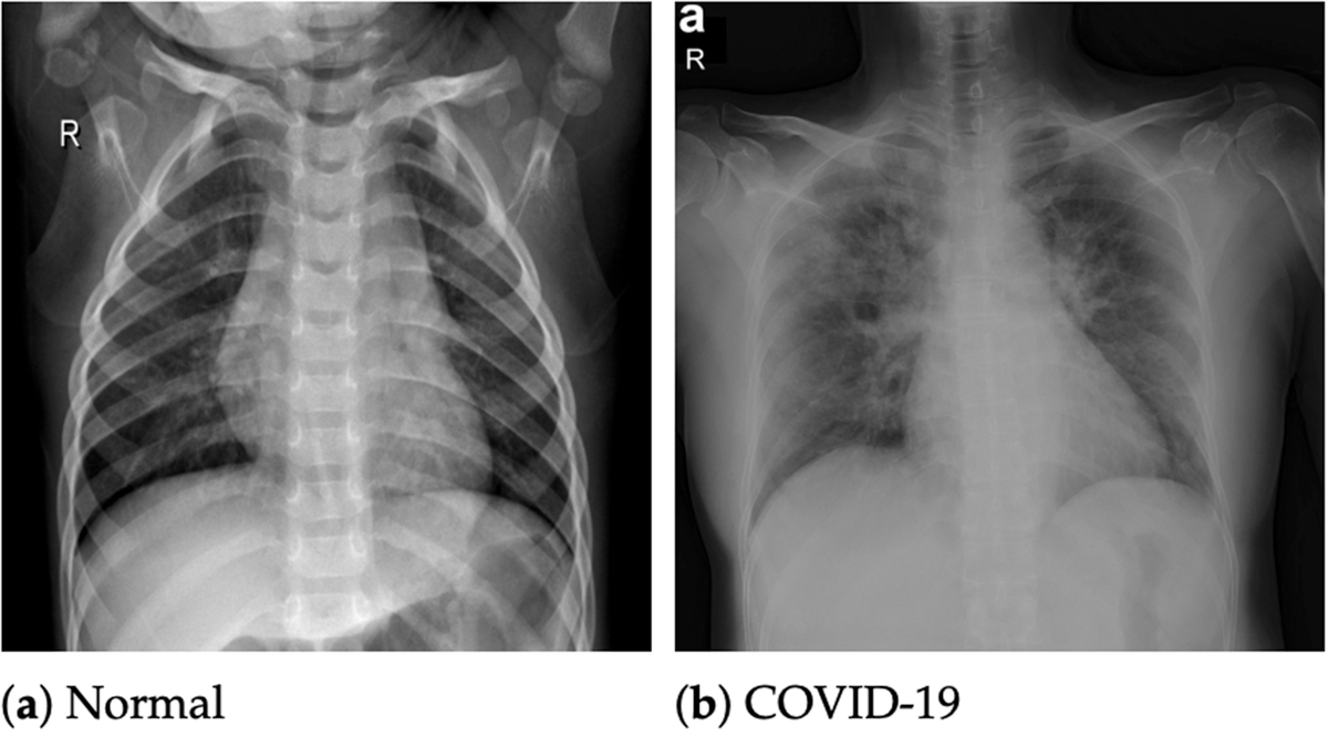 ‘Game-changing’ X-ray technology can diagnose Covid within minutes ...