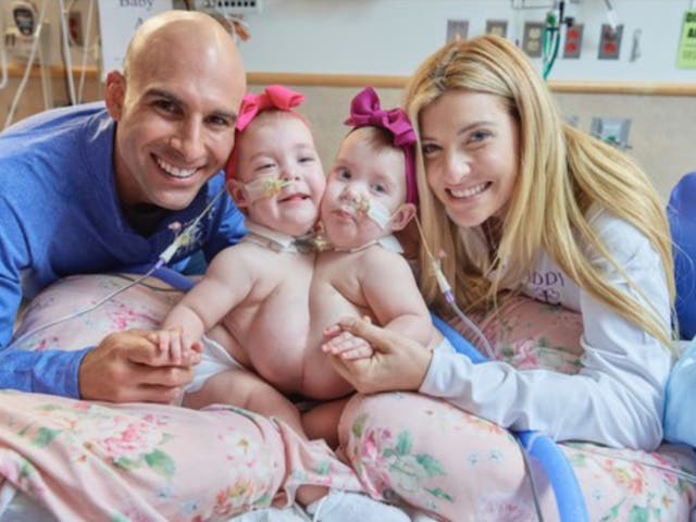 <p>Dom and Maggie Altobelli with their twin daughters Addison and Lilianna. The couples’ daughters were conjoined, but were separated during a surgery at the Children’s Hospital of Philadelphia.</p>