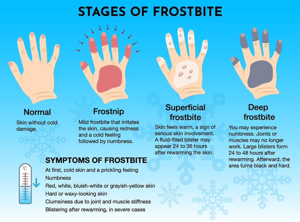 Frostbite Symptoms How Cold Does It Need To Be To Get It And How Fast