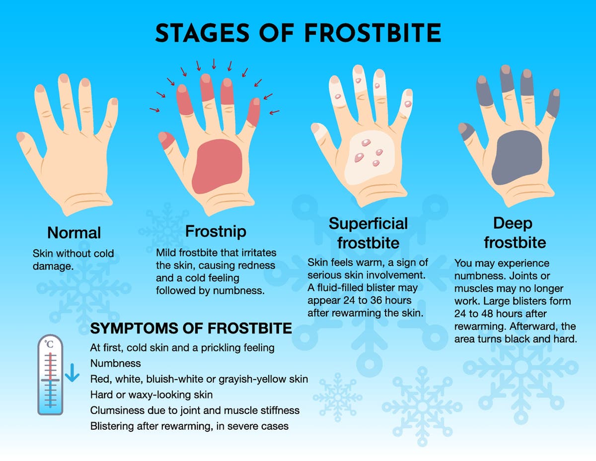 Frostbite in extreme cold: Symptoms, treatment, what you need to know