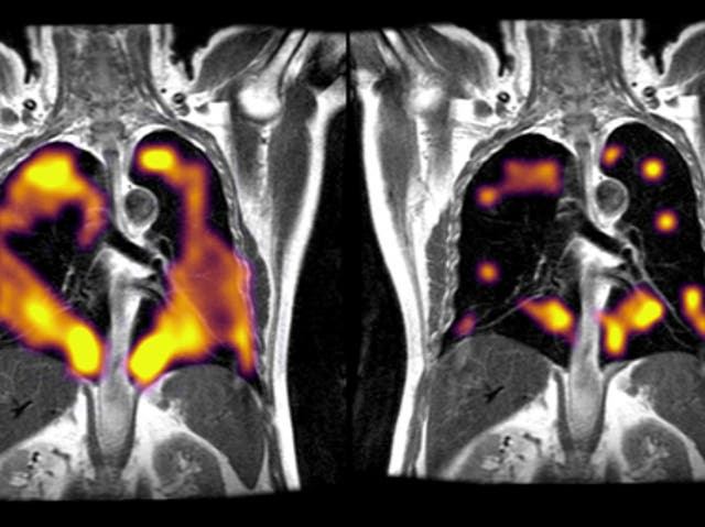 <p>Researchers used xenon gas to detect potential lung damage in patients experiencing periods of breathlessness after having had the virus</p>