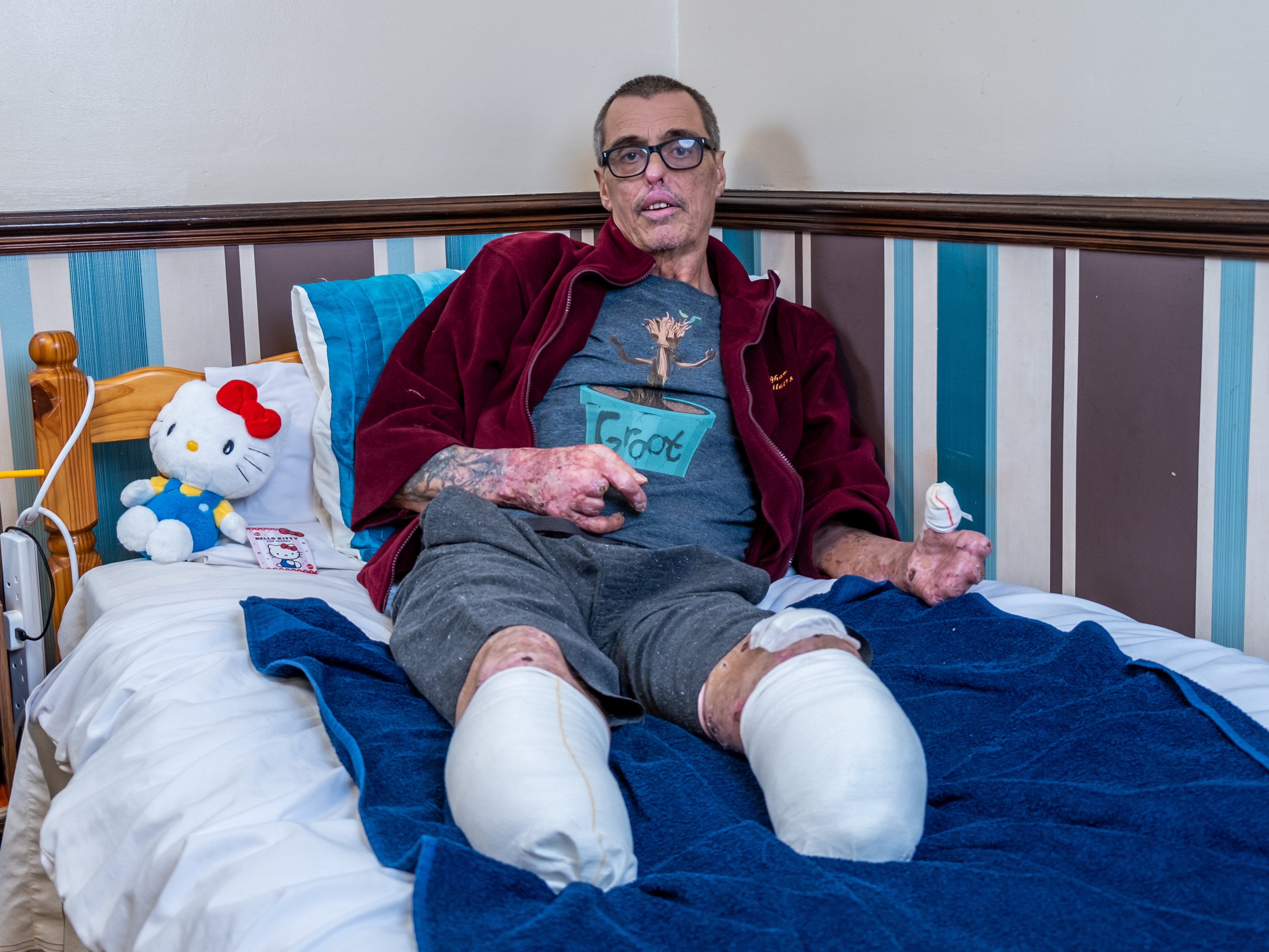 <p>Mark Day, 61 at his home in Colchester after his operation</p>