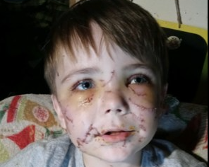 Conner Landers was mauled as he got off the school bus.