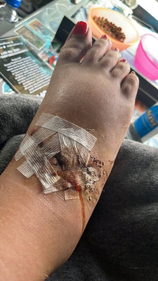 Heather's shark bite after her lucky escape
