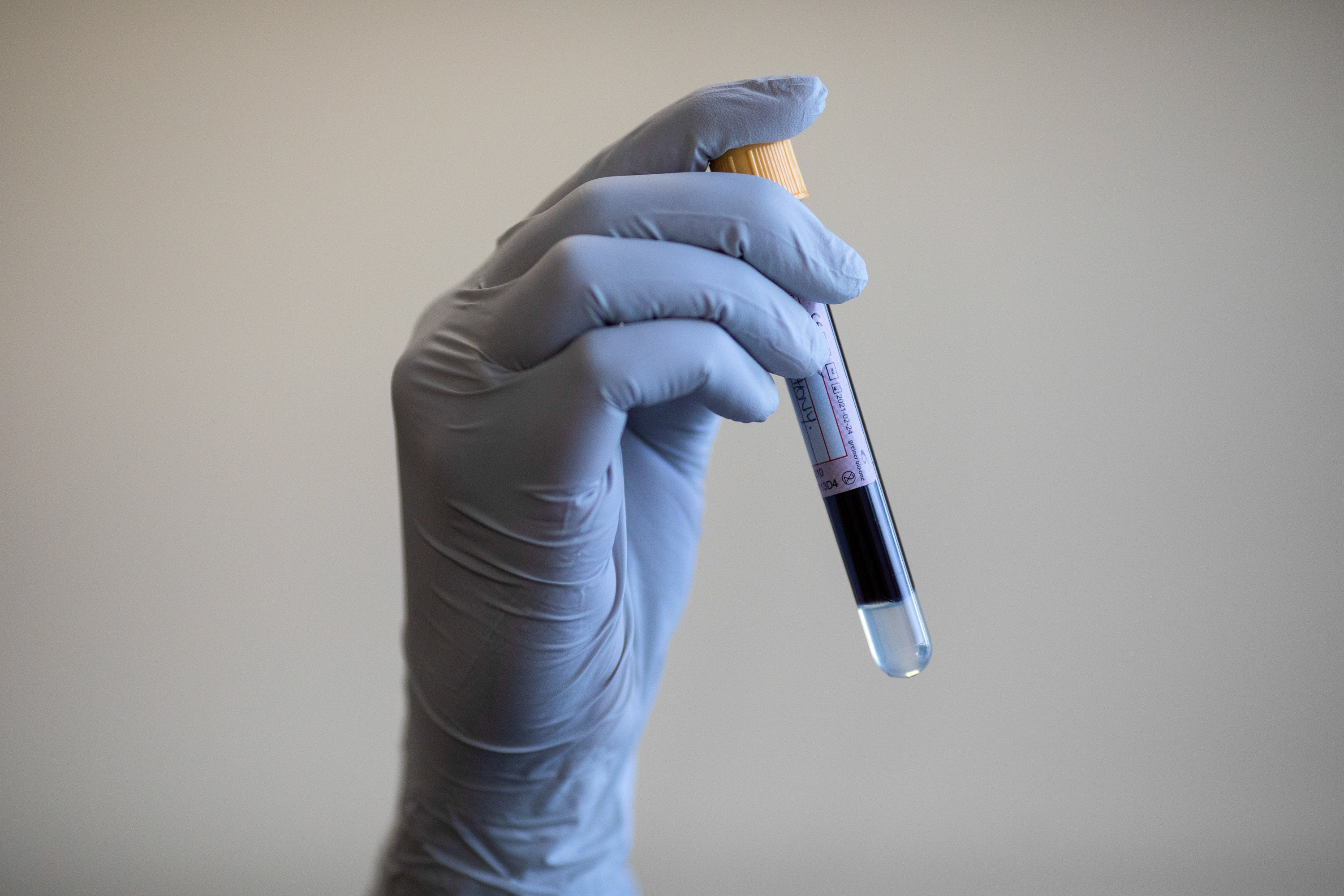 Just 5ml of blood is needed for the test that detects circulating tumour cells