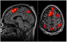 Brain scan reveals patient’s ‘last thoughts’ just before they died in landmark study