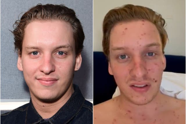 <p>George Ezra, pre- and post- contracting chicken pox</p>