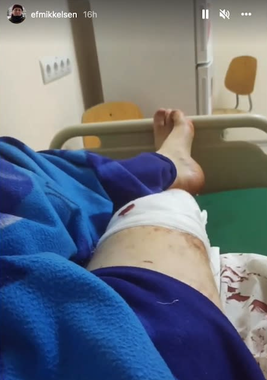 Emil Filtenborg posted a photo from hospital of the gunshot wounds to his legs