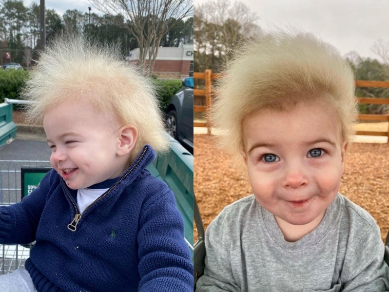 Humberston boys pride in rare uncombable hair condition  BBC News