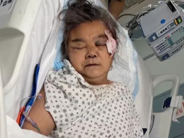<p>GuiYing Ma, 61, a woman from Queens, lies in a hospital bed after an individual attacked her with a rock in November</p>