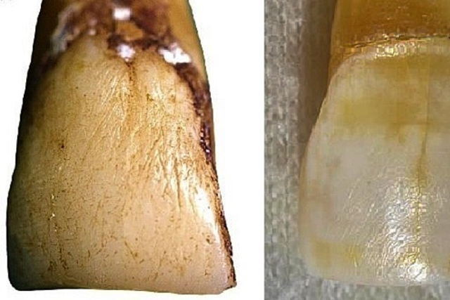 <p>Koshima Island macaque (left) and Neandertal (right), both upper central incisors showing large vertical scratches</p>