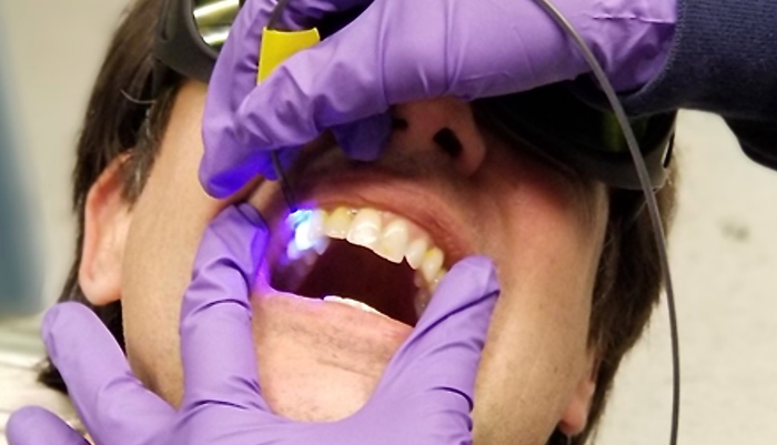 New dental tool prototype uses low-power light system to monitor reactions with a florescent dye solution to find where teeth enamel is most at risk from the acidity of plaque