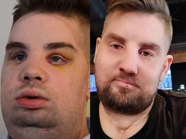 <p>Mitch Hunter, the third person in the world to receive a full face transplant, shortly after his initial operation in 2011, left, and March 2022, right. Mr Hunter suffered severe electrical burns to his face after a car he was in smashed into a 10,000 volt electrical pylon. </p>