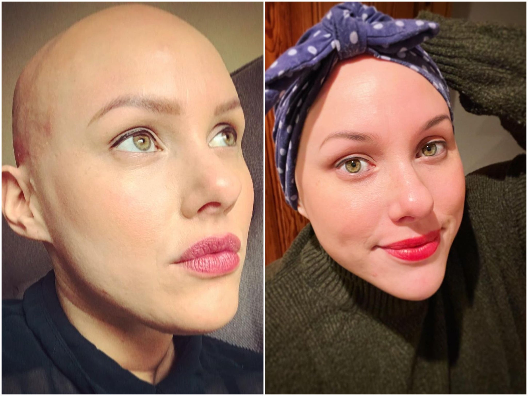 Laura Mathias, who campaigns for alopecia awareness