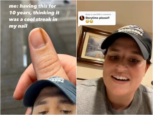 <p>Maria Sylvia revealed on TikTok that a ‘streak’ under her nail was actually a rare form of cancer</p>