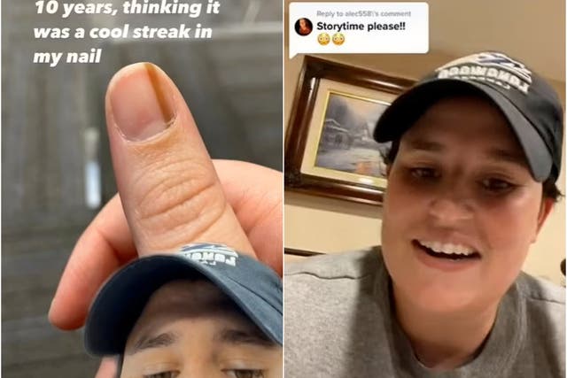 <p>Maria Sylvia revealed on TikTok that a ‘streak’ under her nail was actually a rare form of cancer</p>