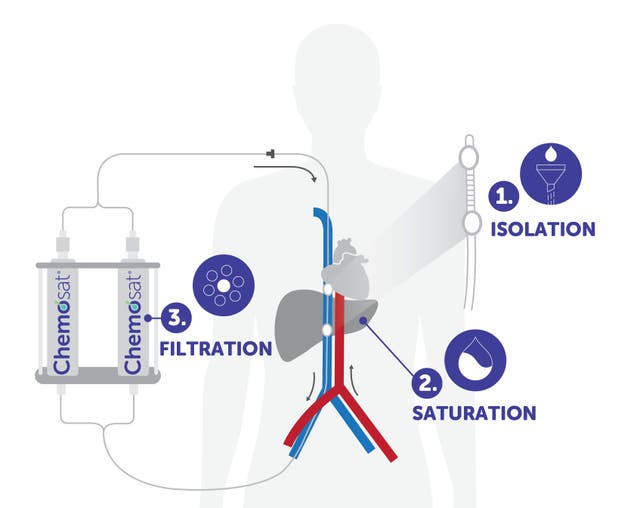 Chemosaturation therapy is being pioneered at University Hospital Southampton to tackle liver cancer (Planets/PA)