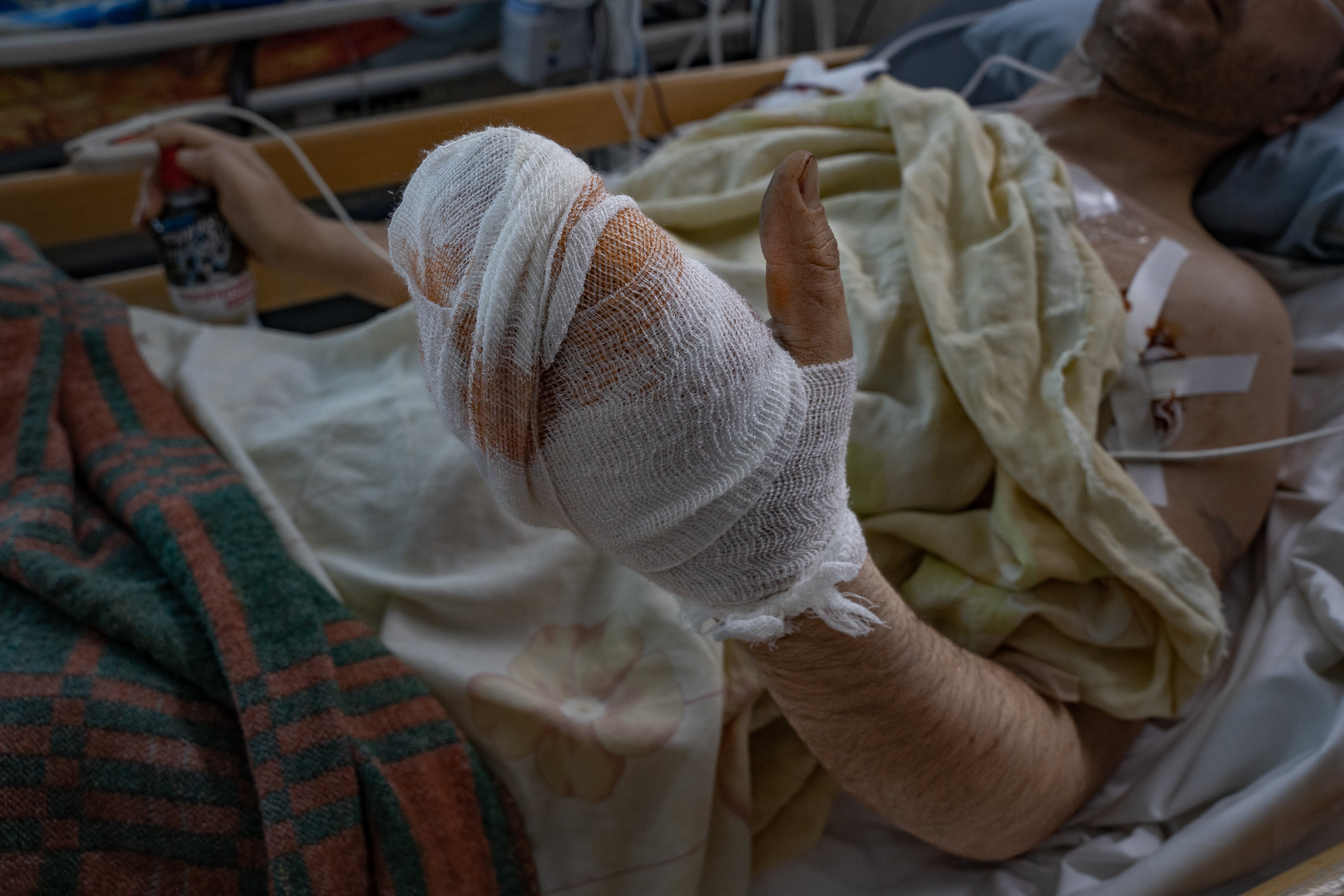 Dima, who picked up an unexploded cluster bomblet, shows how part of his hand is now missing while recovering in a hospital in Mykolaiv