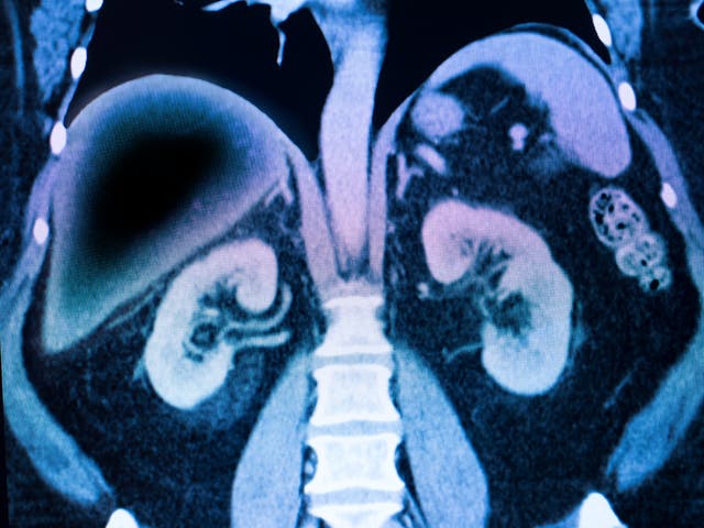 <p>Non-alcoholic fatty liver disease (NAFLD) is triggered when large amounts of fat gather and can result in inflammation, scarring and organ failure </p>