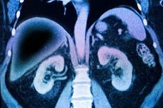 One in four adults ‘living with liver disorder caused by over-eating’