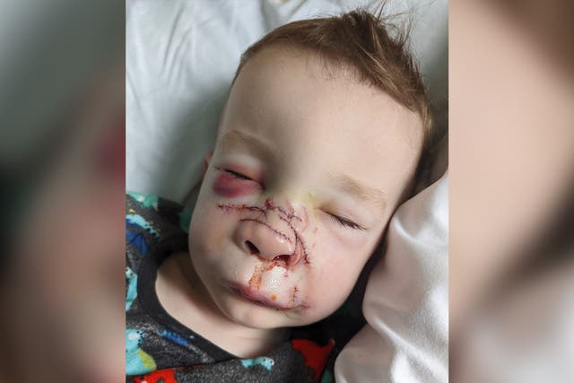<p>Two-year-old Romy Griffiths’ face after the family dog bit him </p>