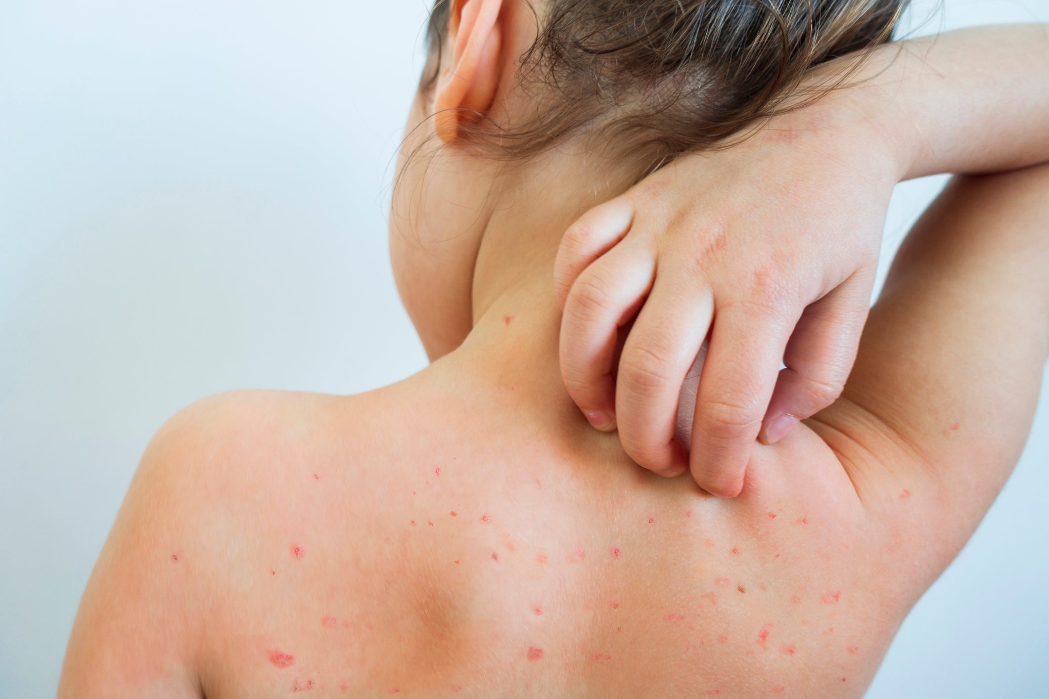 Like every other household in the UK containing a primary-aged small, it seems, chicken pox has arrived