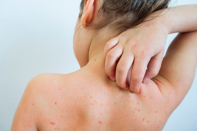 <p>Like every other household in the UK containing a primary-aged small, it seems, chicken pox has arrived</p>
