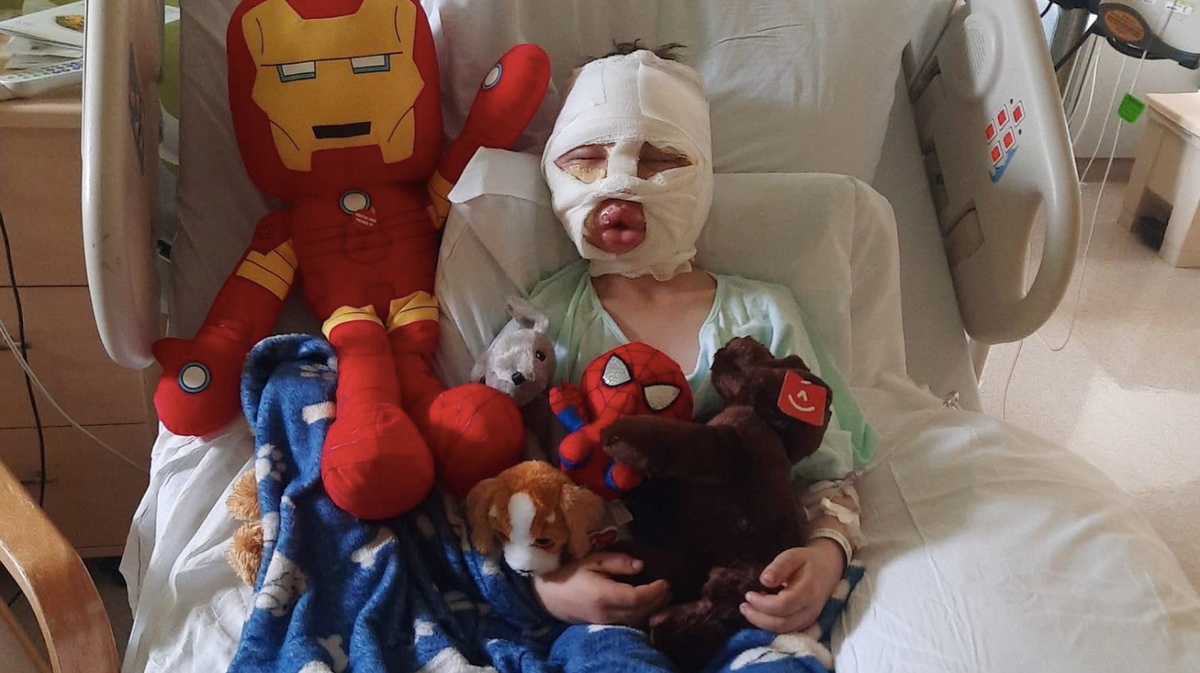 Six-year-old boy suffers third-degree burns in bullying attack: ‘Mommy they lit me on fire’