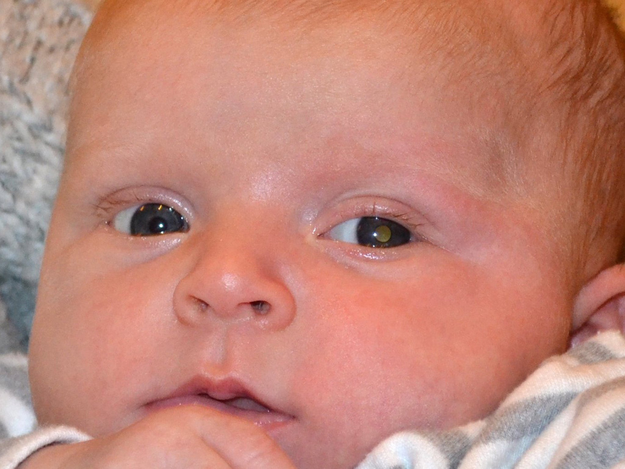 Retinoblastoma: Eye cancer in children causes white reflection in pupil