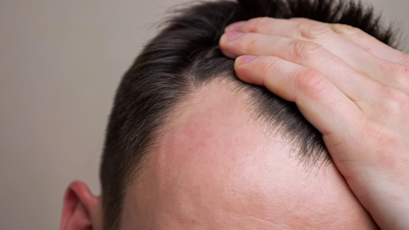 Baldness can affect both men and women