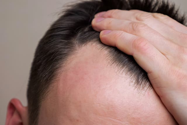 <p>Baldness can affect both men and women </p>