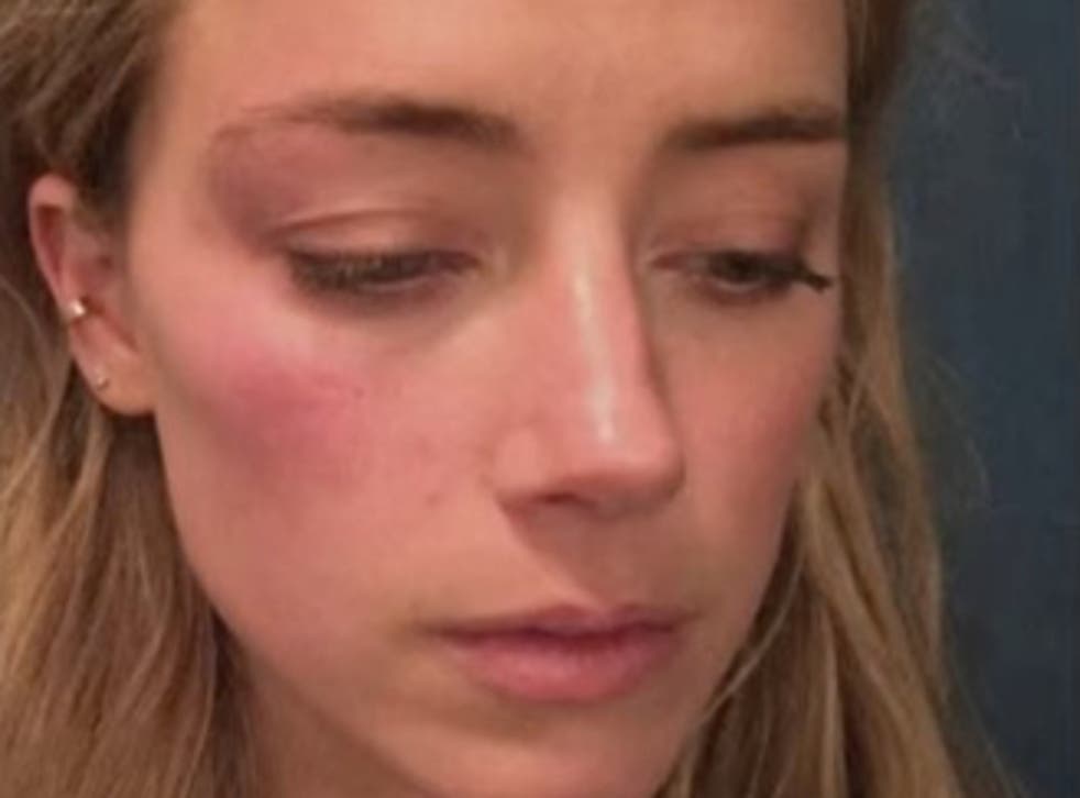 <p>La abogada de Johnny Depp acusó a Amber Heard de retocar las fotos de su cara con heridas como la de arriba</p>