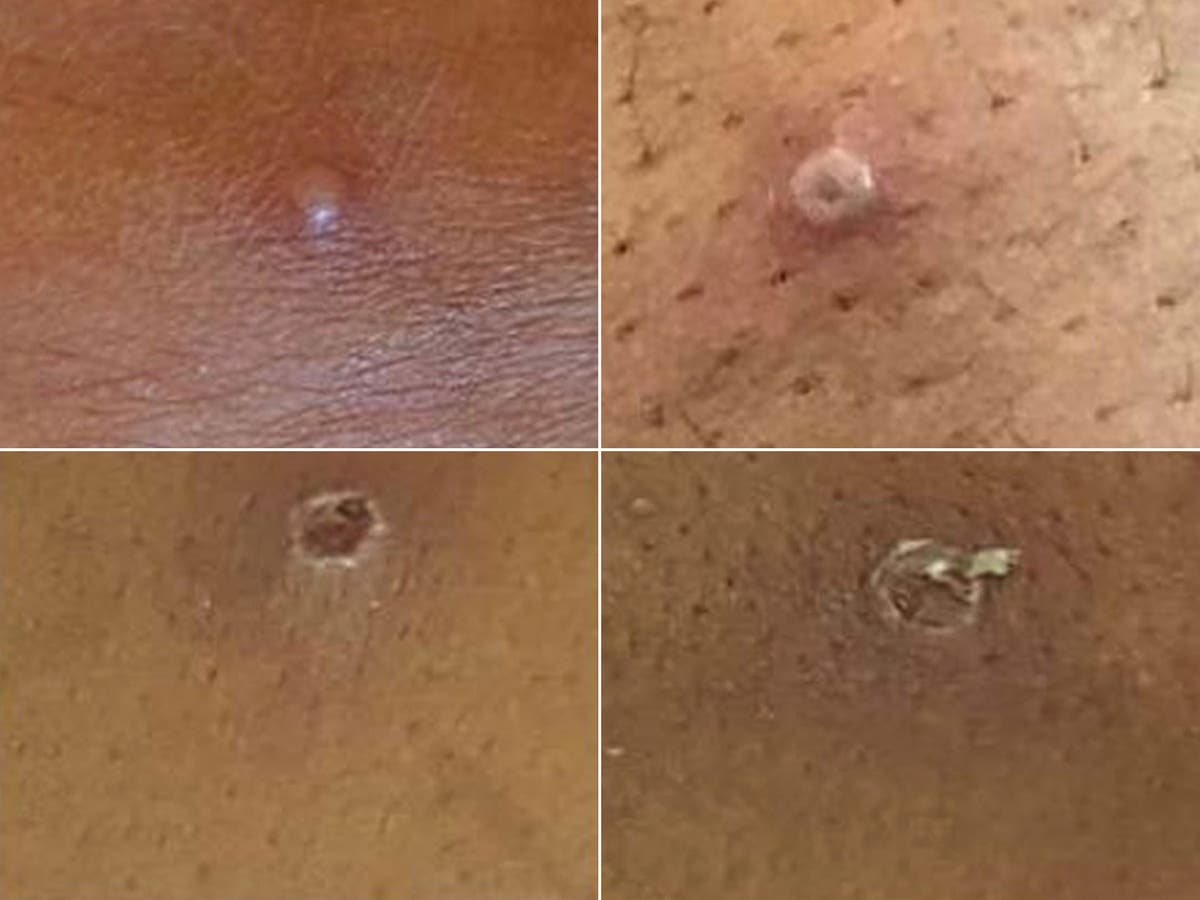 Two more cases of monkeypox found in UK