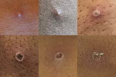 Monkeypox tracker ‘being developed to track UK cases’