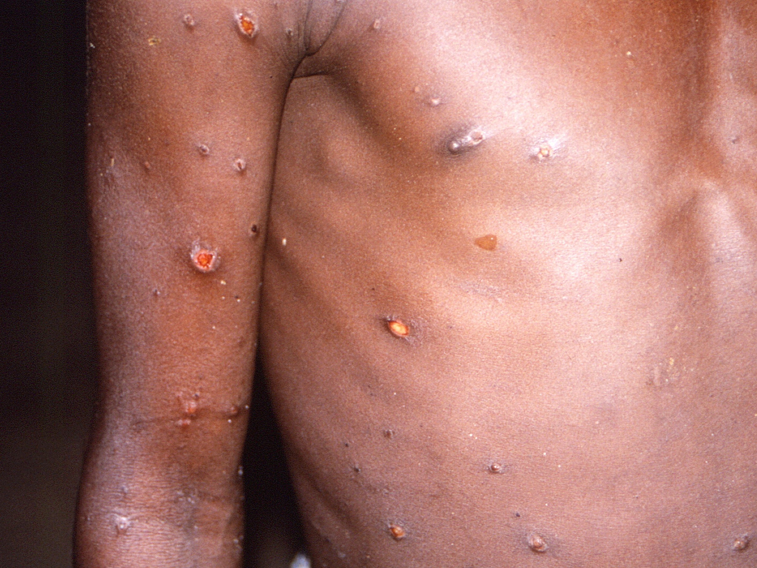 Monkeypox was first detected in the Democratic Republic of the Congo in 1970