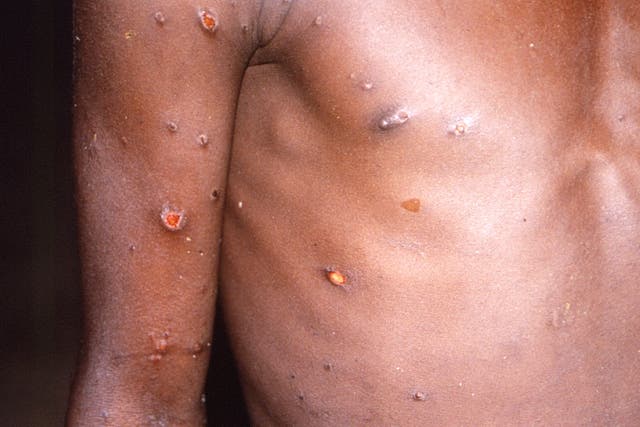 <p>Monkeypox, a disease that rarely appears outside Africa, has been identified by European and American health authorities in recent days</p>