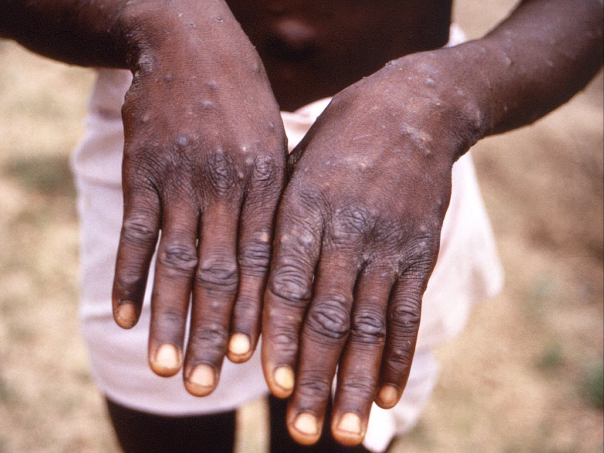 Monkeypox signs and symptoms: What to look for and how it spreads