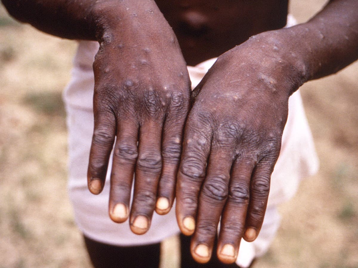 Monkeypox news – latest: WHO holding daily meetings amid Europe’s largest outbreak - The Independent