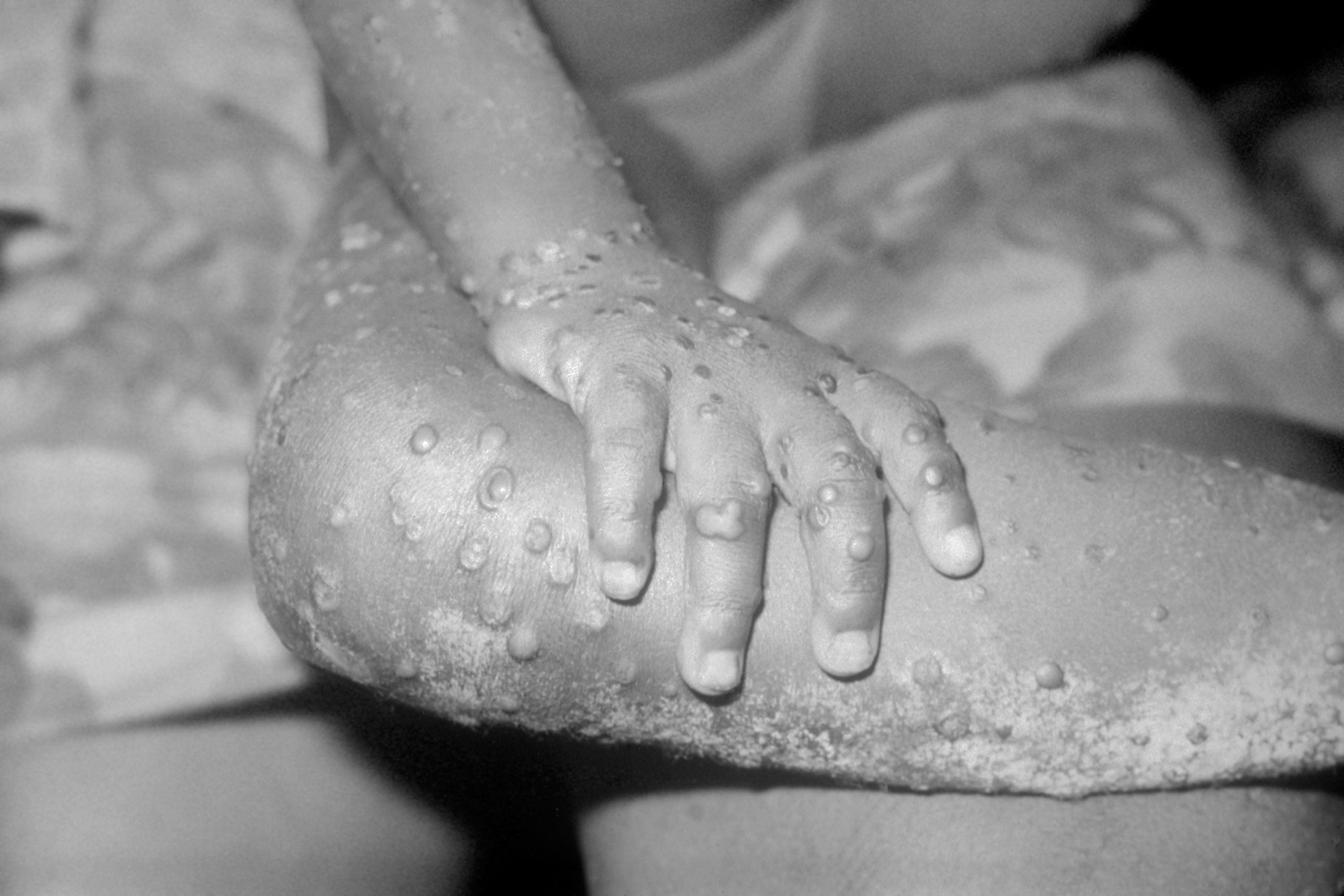 Eleven more cases of monkeypox have been confirmed in the UK, bringing the total to 20 (Alamy/PA)