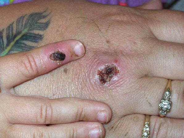 Monkeypox lesions may look like chickenpox and form scabs